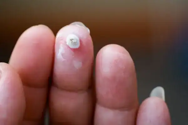 Image of white wart before cryopen treatment Willesden