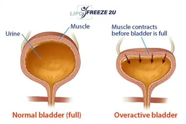 diagram of overactive bladder treatment Willesden