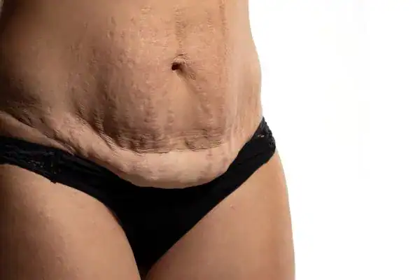 loose skin after weight loss injections Willesden