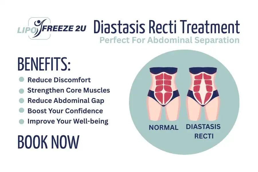 Benefits of body toning treatment Willesden for Diastasis recti