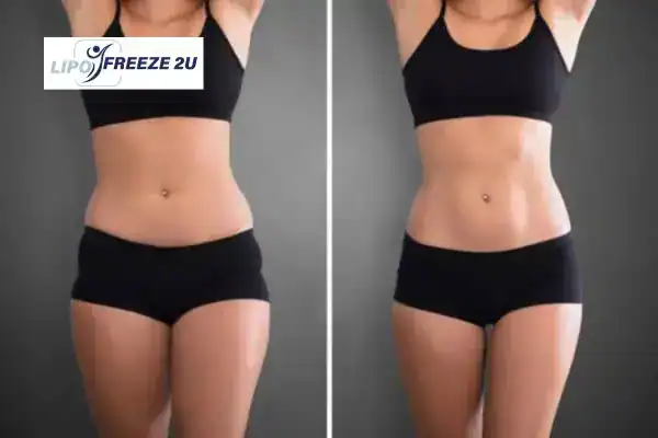How Can LIPO FREEZE 2U Support Your Post-Pregnancy Body Recovery Willesden?