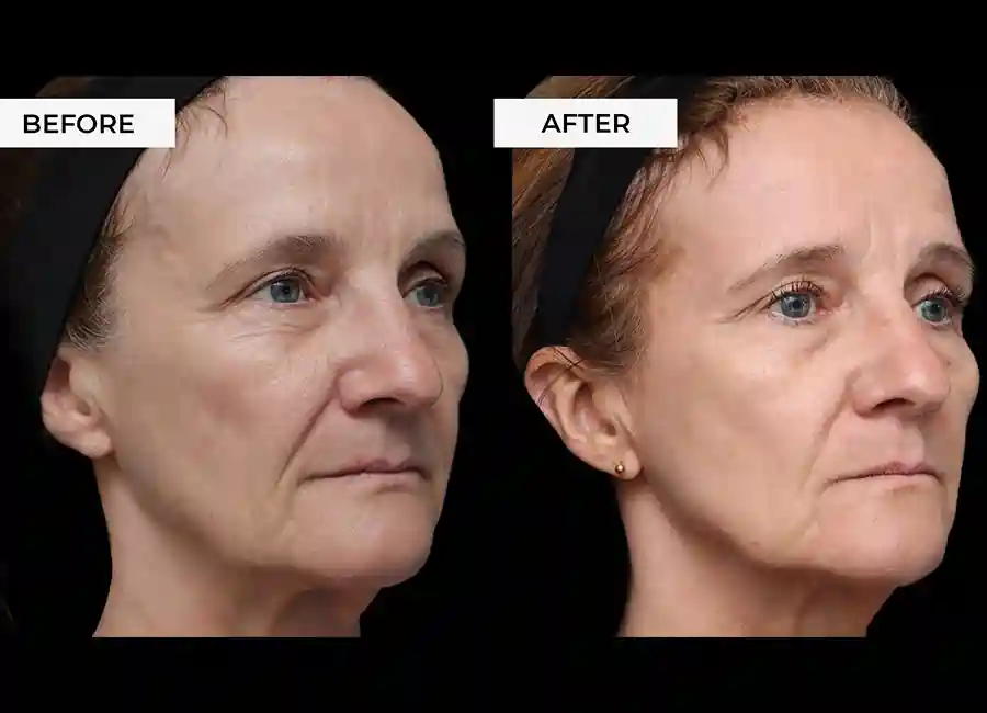 How Many RF Microneedling Sessions Will You Need to See a Difference Willesden?