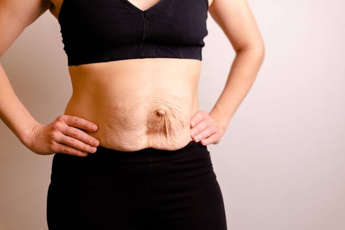 Is Surgery Really the Only Way to Repair Diastasis Recti Willesden?