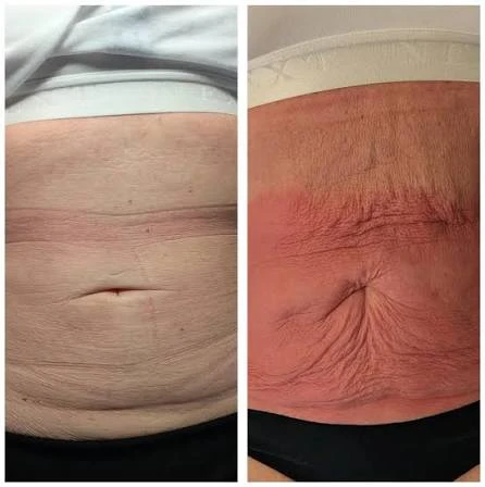 How Does RF Microneedling Improve Crepey, Thin and Uneven Skin Texture Willesden?