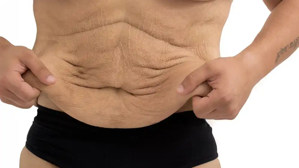 Why Does Weight Loss Medication Leave Some People With Loose or Sagging Skin Willesden?